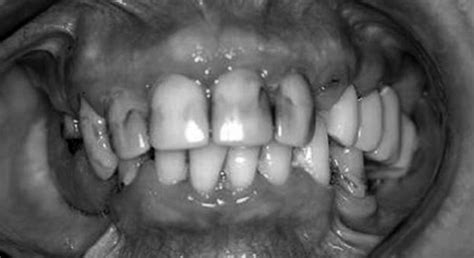 Frontal view of the occlusion | Download Scientific Diagram