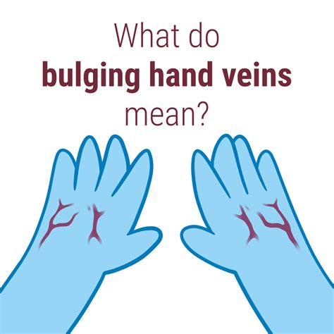 Causes of Bulging Veins - Delaware Vein Center