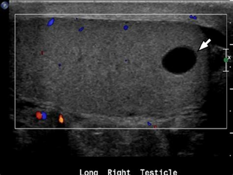 Testicular Cyst Ultrasound