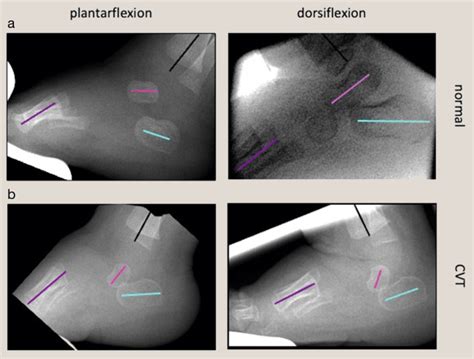 Understanding Congenital Vertical Talus Orthopaedics And Trauma