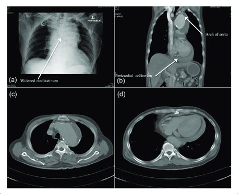 A Cxr Showing Widened Mediastinum B To D Ct Thorax Showing The Download Scientific