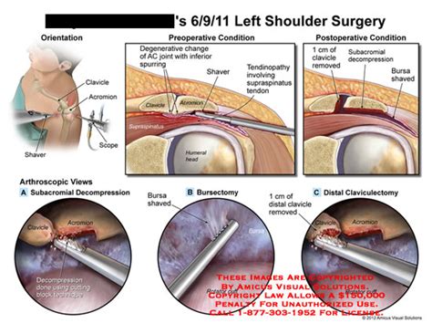 Subacromial Decompression Surgery Centreville Va Shou