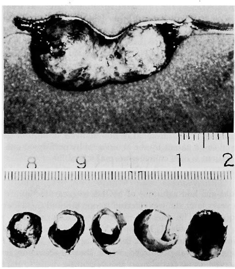 Figure 2 From Cardiac Surgery Of Eight Children With Kawasaki Disease