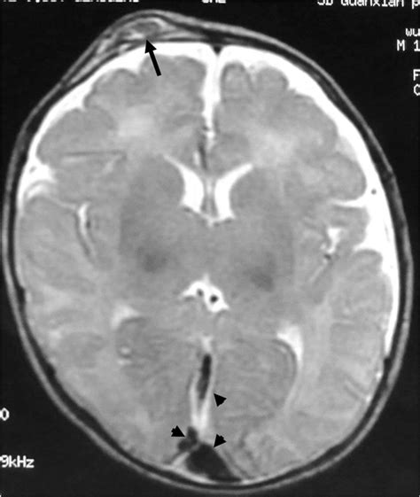 MR imaging, axial, T2-weighted, showing a small right frontal scalp ...