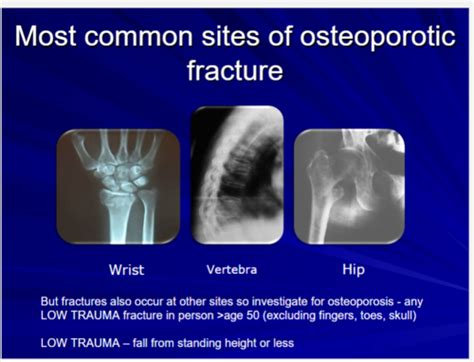 bone remodelling and osteoporosis Flashcards | Quizlet