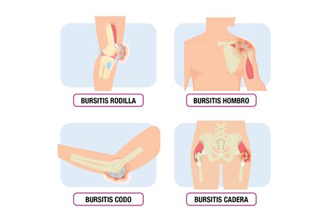 Bursitis y Quiropráctica QUIROPRACTICA BARCELONA