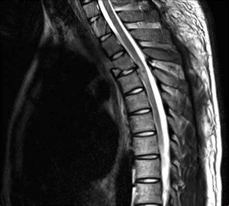 Thoracic Spine Teardrop Fracture A Case Report Journal Of