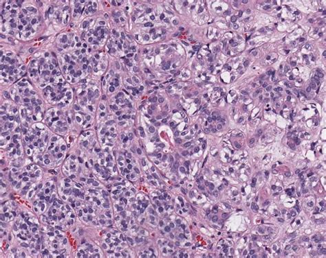 Yale Pathology On Twitter Epithelial Myoepithelial Carcinoma Emc