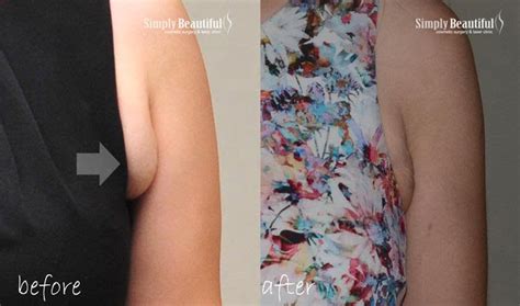 Lipo Dissolve Fat Dissolving Injection Dr Peter Kim Surgery Skin