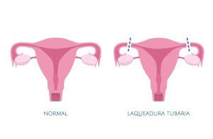 O Que Laqueadura Tub Ria Dra Cristiane Pacheco