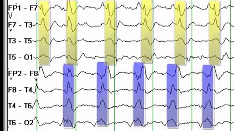 Eeg Reading Rounds Bipleds Youtube