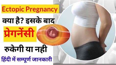 Ectopic Pregnancy In Hindi Causes Signs Symptoms Treatment