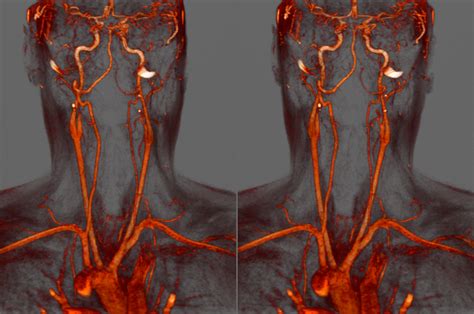 Voxel123 Head And Neck Stereoscopic Mri