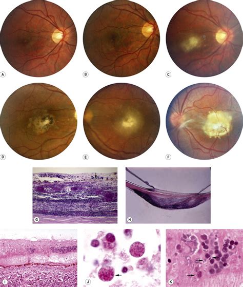 Infectious Diseases Of The Retina And Choroid Ento Key