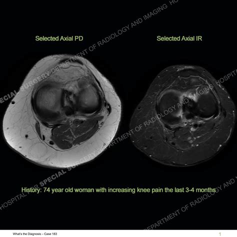 Hss Whats The Diagnosis Case 183 By Hospital For Special Surgery Issuu