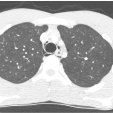 CT scan showing pneumomediastinum. | Download Scientific Diagram