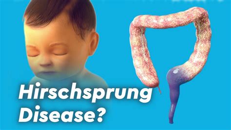 Hirschsprung Disease Signs And Symptoms