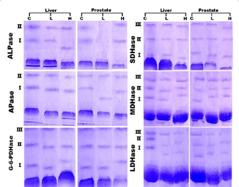 Isoenzyme electrophoresis of alkaline phosphatase (ALP ase), acid ...