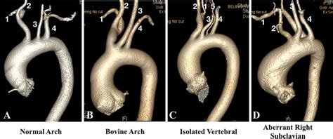 Aortic arch branching patterns: A normal aortic arch, B bovine aortic ...