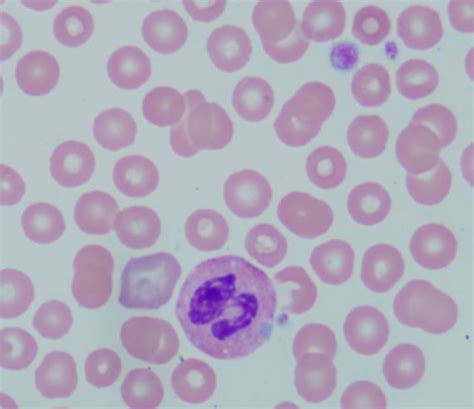 Hematopathology For General Pathology Boards Flashcards Quizlet