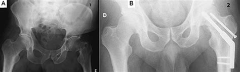 Pre And Postoperative Antero Posterior Bilateral Hip View Radiographs