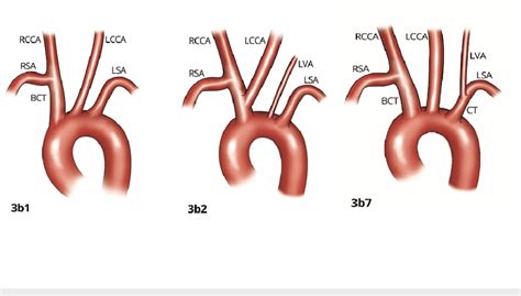 Subgroups Of Branching That Originate From The Aortic Arch As Three Download Scientific Diagram