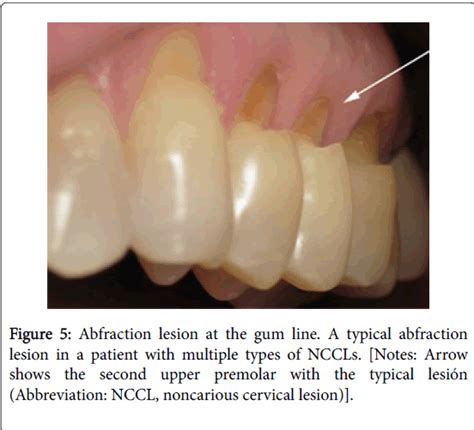 Noncarious Cervical Lesions As Abfraction Etiology Diagnosis And