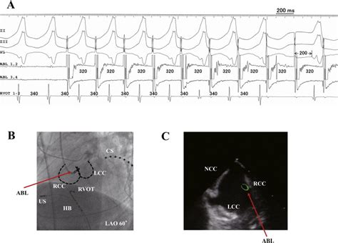 A Intracardiac Electrogram Showing Overdrive Pacing From The Lcc Rcc