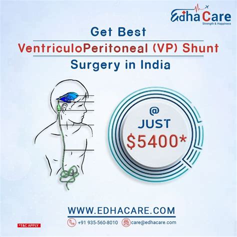 VentriculoPeritoneal V P Shunt In 2023 Vp Shunt Medical Tourism