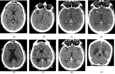 A Initial Presentation Ct Head In Ed Shows No Abnormality B