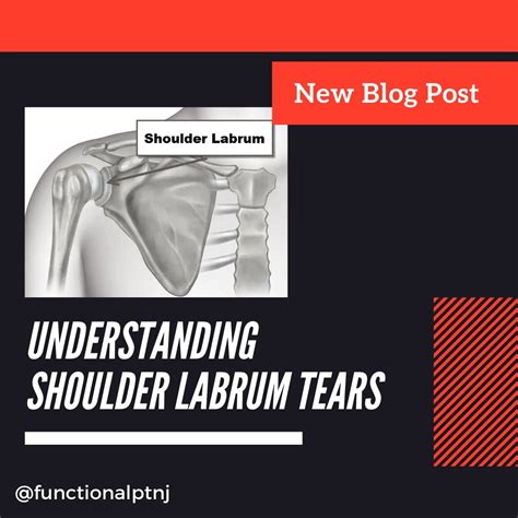 Understanding Shoulder Labrum Tears