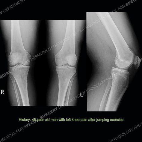 Hss Whats The Diagnosis Case 180 By Hospital For Special Surgery Issuu