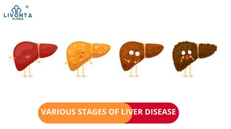 Various Stages Of Liver Disease Livonta Global Pvt Ltd