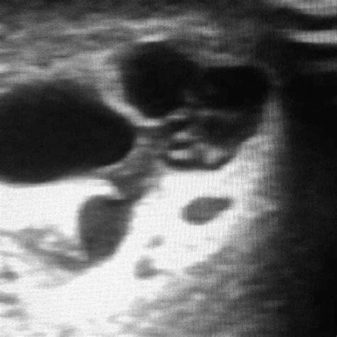 Real Time Ultra Sound Scanning Of Scrotum Revealed Increased