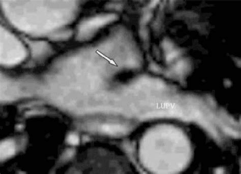 Pdf The Coumadin Ridge An Important Example Of A Left Atrial