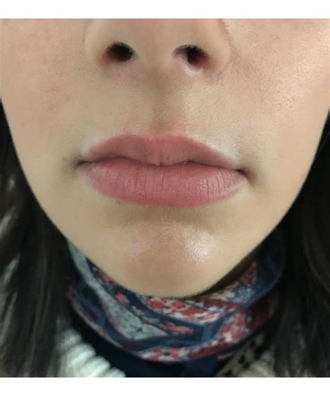 Swollen Lips After Kissing Lipstutorial Org