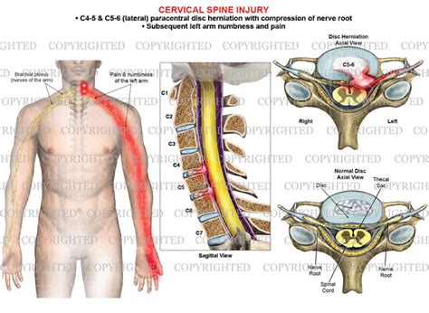 2 Level C4 5 And C5 6 Disc Herniation Paracentral Left Arm Nerve