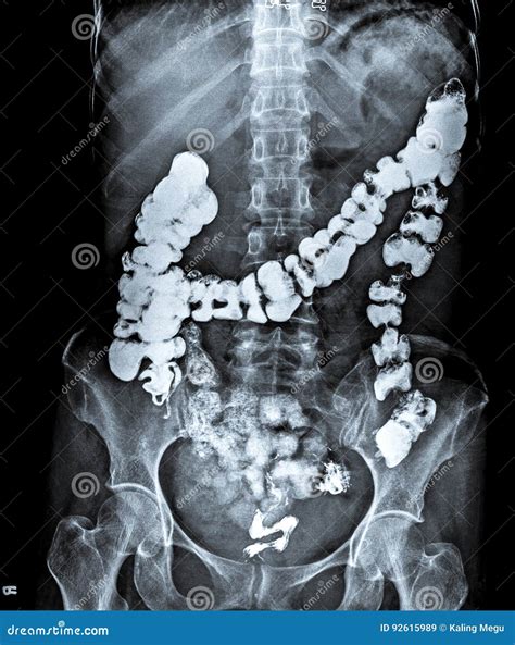 X Ray Of Abdomen With Large Intestine Stock Image