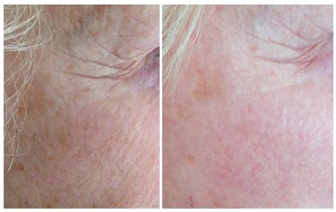 Vi Peel Before And After Darst Dermatology Charlotte Dermatologist