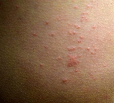 It Happens Dealing With Scabies — Savvy Dispatches