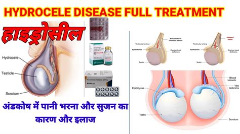 Hydrocele Disease Full Treatment अंडकोष में पानी भरना और सुजन का