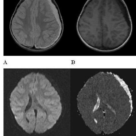 A D Thirty Years Old Male Who Has A Right Frontoparietal Subdural