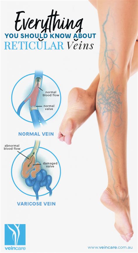 Everything You Should Know About Reticular Veins Veincare