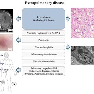 Alpha Antitrypsin Deficiency Aatd Extrapulmonary Manifestations