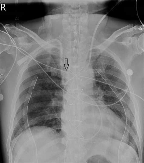 Intraoperative Chest Radiograph After Swan Ganz Catheter Insertion The Download Scientific