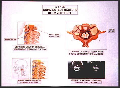 Howell Medigraphics Medical Illustration Of The Month