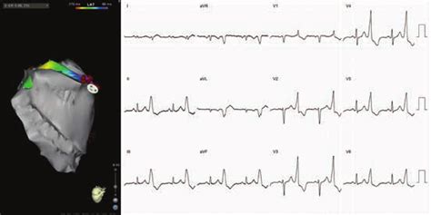 Ecg And Anatomic Location Of Successful Ablation Sites For An Amc Pvc