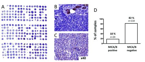 Fig S3 In Situ Expression Of MICA B In MCC Lesions In Tissue