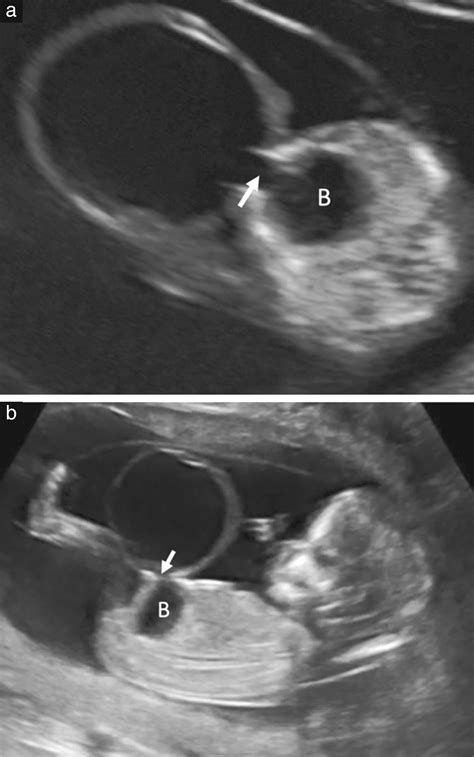 Abnormal Ultrasound Weeks