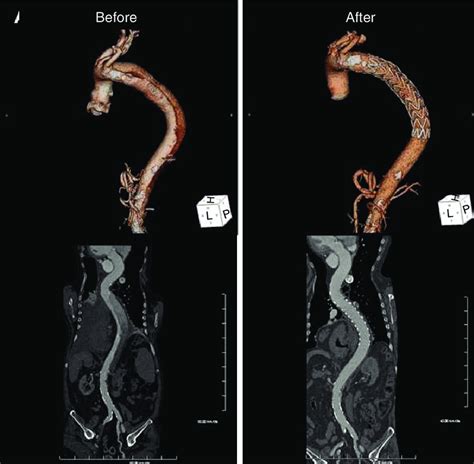 Computed Tomography Volume Rendering Technique VRT Top And Curved